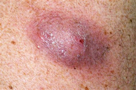 infected sebaceous cyst